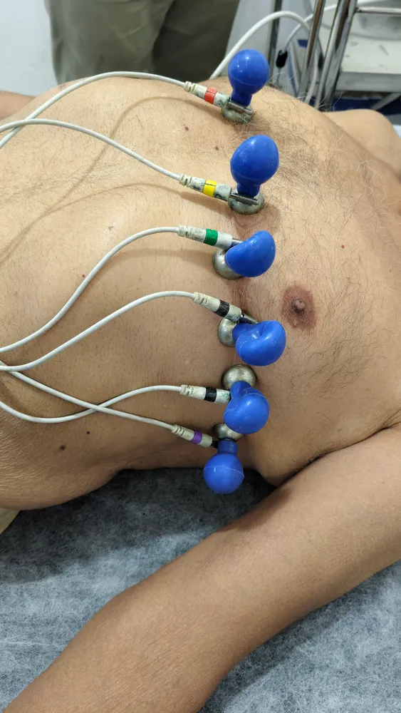 อุปกรณ์ตรวจคลื่นไฟฟ้าหัวใจ (ECG) ติดที่หน้าอกผู้ป่วยเพื่อติดตามจังหวะการเต้นของหัวใจ
