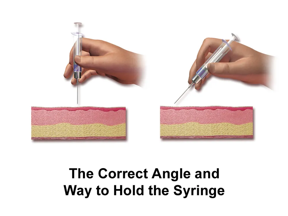 Illustration of a subcutaneous injection