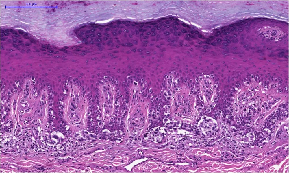 Microscopy image: Melanoma cells in skin tissue — the personalized mRNA vaccine is designed to train immune cells to detect and destroy cancer cells like these that may remain after surgery. (Image: Wikimedia Commons — CC)