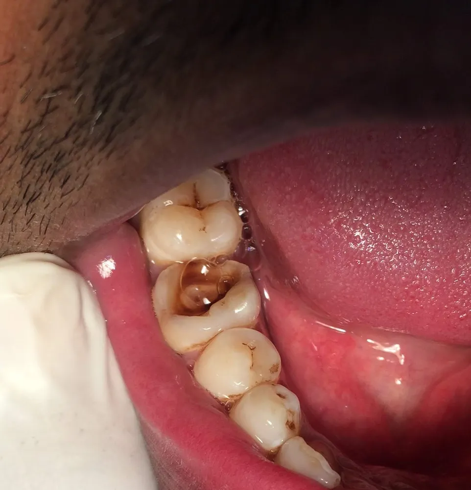 Advanced tooth decay (illustrative)
