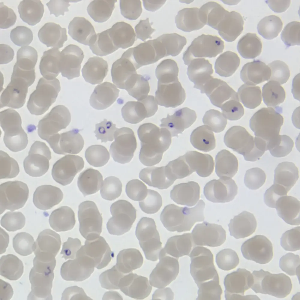 เชื้อมาลาเรีย Plasmodium falciparum ในเซลล์เม็ดเลือดแดงเมื่อมองผ่านกล้องจุลทรรศน์